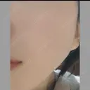 ボトックス（エラ・小顔） 湘南美容クリニック 本厚木院 DAY 17 サムネイル用