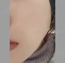 ボトックス（エラ・小顔） 湘南美容クリニック 本厚木院 DAY 21 サムネイル用