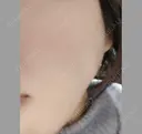 ボトックス（エラ・小顔） 湘南美容クリニック 本厚木院 DAY 34 サムネイル用