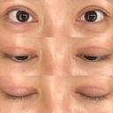 二重切開 / 目頭切開 / クマ治療 / 目尻切開 / 上まぶたたるみ取り / 下まぶたの脂肪取り / 脂肪注入（目の下） 湘南美容クリニック 大阪堺東院 DAY 62 サムネイル用