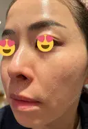 ハイフ（顔） 湘南美容クリニック 高崎院 DAY 8 サムネイル用