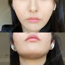 糸リフト / 脂肪吸引（顔） 東京美専クリニック DAY 16 サムネイル用