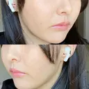 糸リフト / 脂肪吸引（顔） 東京美専クリニック DAY 16 サムネイル用