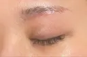 眼瞼下垂（切開） 水の森美容クリニック 福岡院 DAY 30 サムネイル用