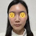 ボトックス（眉間） スキンリファインクリニック銀座 DAY 17 サムネイル用