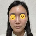 ボトックス（眉間） スキンリファインクリニック銀座 DAY 17 サムネイル用