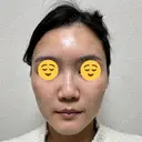 ボトックス（眉間） スキンリファインクリニック銀座 DAY 18 サムネイル用