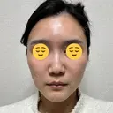 ボトックス（眉間） スキンリファインクリニック銀座 DAY 18 サムネイル用