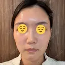 ボトックス（眉間） スキンリファインクリニック銀座 DAY 19 サムネイル用