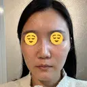 ボトックス（眉間） スキンリファインクリニック銀座 AFTER サムネイル用