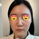 ボトックス（眉間） スキンリファインクリニック銀座 DAY 21 サムネイル用