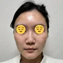 ボトックス（エラ・小顔） スキンリファインクリニック銀座 DAY 18 サムネイル用