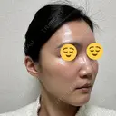 ボトックス（エラ・小顔） スキンリファインクリニック銀座 DAY 18 サムネイル用