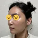 ボトックス（エラ・小顔） スキンリファインクリニック銀座 DAY 18 サムネイル用