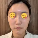 ボトックス（エラ・小顔） スキンリファインクリニック銀座 DAY 19 サムネイル用