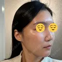 ボトックス（エラ・小顔） スキンリファインクリニック銀座 DAY 20 サムネイル用