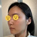 ボトックス（エラ・小顔） スキンリファインクリニック銀座 DAY 20 サムネイル用