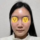 エレクトロポレーション 湘南美容クリニック Regno 銀座院 DAY 2 サムネイル用