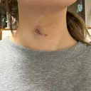 肌ヒアルロン酸注入（たるみ・シワ改善） ルラ美容クリニック 名古屋本院 DAY 1 サムネイル用