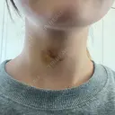 肌ヒアルロン酸注入（たるみ・シワ改善） ルラ美容クリニック 名古屋本院 DAY 4 サムネイル用