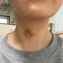 肌ヒアルロン酸注入（たるみ・シワ改善） ルラ美容クリニック 名古屋本院 DAY 5 サムネイル用