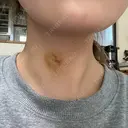 肌ヒアルロン酸注入（たるみ・シワ改善） ルラ美容クリニック 名古屋本院 DAY 6 サムネイル用