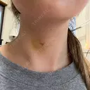 肌ヒアルロン酸注入（たるみ・シワ改善） ルラ美容クリニック 名古屋本院 DAY 8 サムネイル用