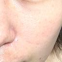 光治療（フォトフェイシャルなど） B-LINE CLINIC 池袋院 AFTER サムネイル用