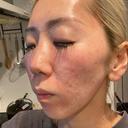 ポテンツァ NARU Beauty Clinic 【ナルクリ】 AFTER サムネイル用