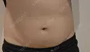 脂肪冷却（お腹） 美容皮膚科エルムクリニック 大阪院 DAY 111 サムネイル用