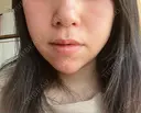 脂肪吸引（顔） / ジョールファット除去 湘南美容クリニック 秋葉原院 DAY 84 サムネイル用