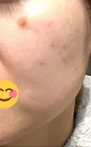 ほくろ・いぼ除去レーザー（肌） / シミ取りレーザー / ピコスポット 日比谷セントラルクリニック DAY 3 サムネイル用