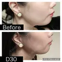 脂肪溶解注射（顔） SK新宿歌舞伎町美容外科・歯科 DAY 30 サムネイル用