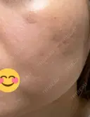 ほくろ・いぼ除去レーザー（肌） / シミ取りレーザー / ピコスポット 日比谷セントラルクリニック DAY 4 サムネイル用