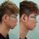 糸リフト / 脂肪吸引（顔） / ジョールファット除去 / 医療痩身（顔） / インディバ（顔） WOM CLINIC GINZA （ワム クリニック ギンザ） DAY 109 サムネイル用
