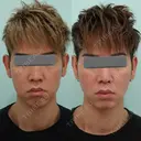糸リフト / 脂肪吸引（顔） / ジョールファット除去 / 医療痩身（顔） / インディバ（顔） WOM CLINIC GINZA （ワム クリニック ギンザ） AFTER サムネイル用