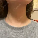 肌ヒアルロン酸注入（たるみ・シワ改善） ルラ美容クリニック 名古屋本院 AFTER サムネイル用