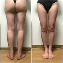 脂肪吸引（脚） / 豊胸（脂肪注入） GAYA body design clinic DAY 61 サムネイル用