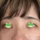 クマ治療 / 脂肪注入（肌） X CLINIC 大阪院 AFTER サムネイル用