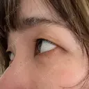 クマ治療 / 脂肪注入（肌） X CLINIC 大阪院 DAY 21 サムネイル用