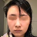 バッカルファット除去 / 脂肪吸引（顔） / ヒアルロン酸注入（鼻） / ボトックス（あご） / 水光注射（ハリ・美肌） / ボトックス（エラ・小顔） / ボトックス（口角） / 白玉点滴・注射 エートップ美容整形外科 DAY 5 サムネイル用