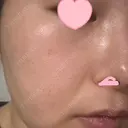 ヴェルヴェットスキン ブリリアスキンクリニック 大宮駅前院 DAY 6 サムネイル用