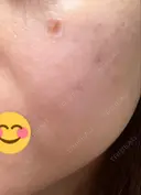 ほくろ・いぼ除去レーザー（肌） / シミ取りレーザー / ピコスポット 日比谷セントラルクリニック DAY 6 サムネイル用