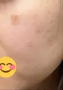 ほくろ・いぼ除去レーザー（肌） / シミ取りレーザー / ピコスポット 日比谷セントラルクリニック DAY 7 サムネイル用