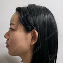 脂肪吸引（脚） / 脂肪吸引（お尻） / 脂肪注入（額） 湘南美容クリニック 京都院 DAY 0 サムネイル用