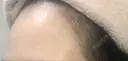 アートメイク（ヘアライン） Tokyo Tensei Clinic 新宿院 DAY 1 サムネイル用