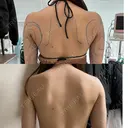 脂肪吸引（二の腕） / 脂肪吸引（肩） 湘南美容クリニック 神戸院 DAY 43 サムネイル用