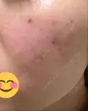 ほくろ・いぼ除去レーザー（肌） / シミ取りレーザー / ピコスポット 日比谷セントラルクリニック DAY 8 サムネイル用