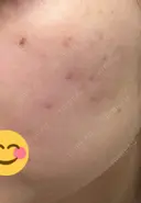 ほくろ・いぼ除去レーザー（肌） / シミ取りレーザー / ピコスポット 日比谷セントラルクリニック DAY 9 サムネイル用