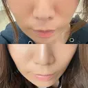 脂肪溶解注射（顔） SK新宿歌舞伎町美容外科・歯科 AFTER サムネイル用